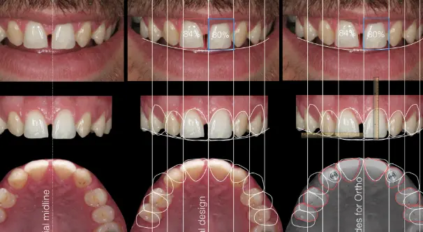 ﻿Congenitally missing teeth﻿